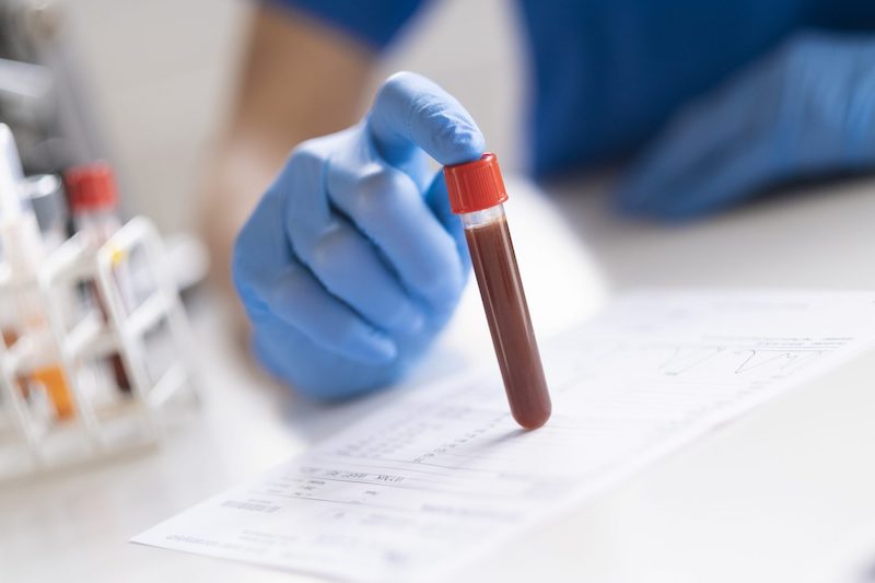 COVID-19 Antibody Testing: Pros & Cons