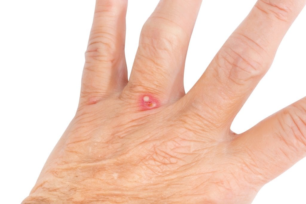 fire ant sting