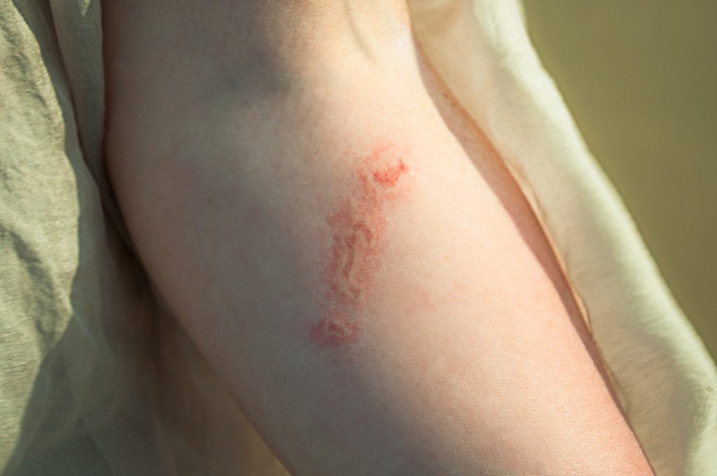 Jellyfish Sting