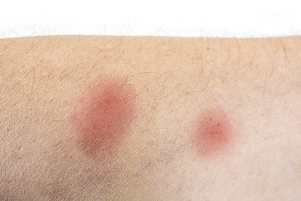 spider bite