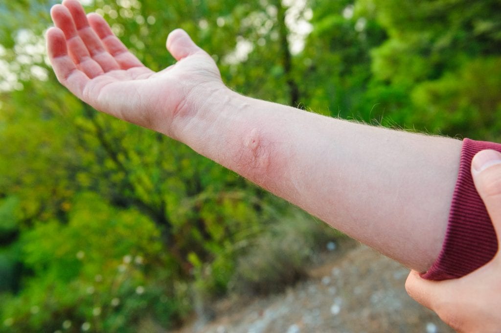 wasp sting on arm