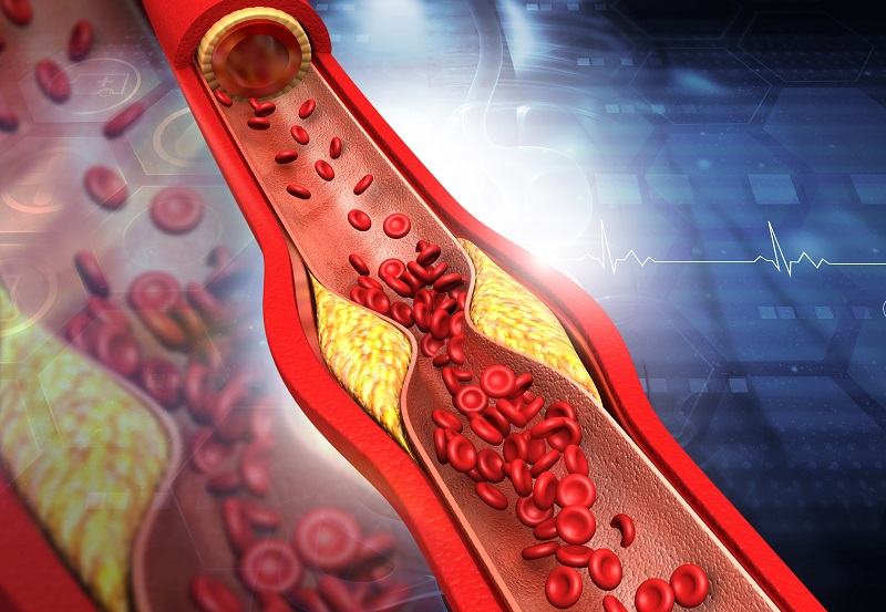 Graphic of a blocked artery. Treatment for blocked arteries.