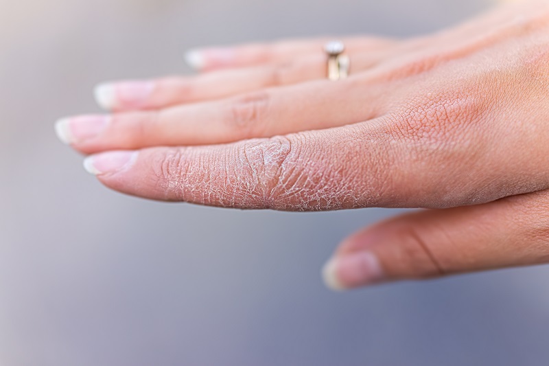 Hand with dry skin
