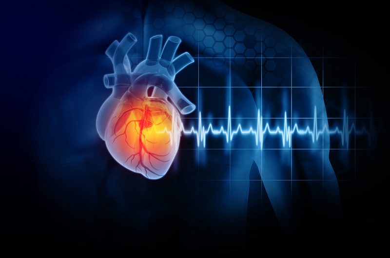 Illustration of cardiac arrest, a heart stopping