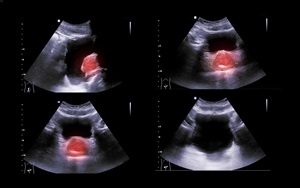 Bladder Cancer