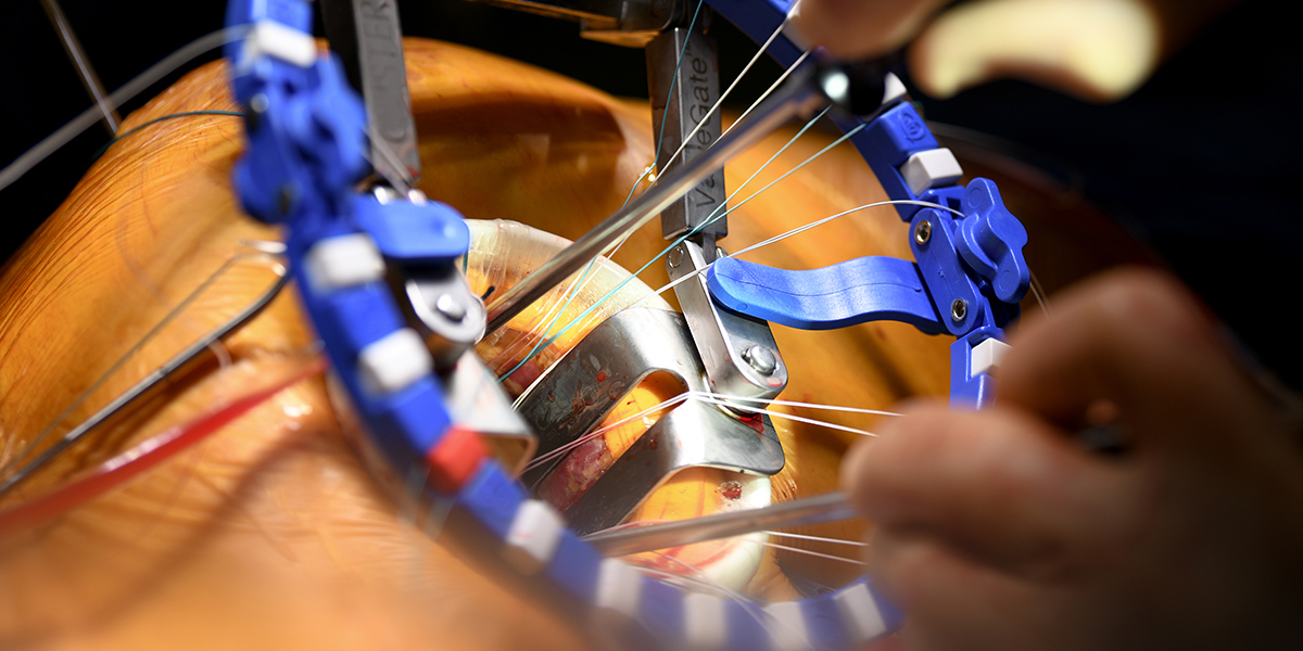 Mitral Valve Repair