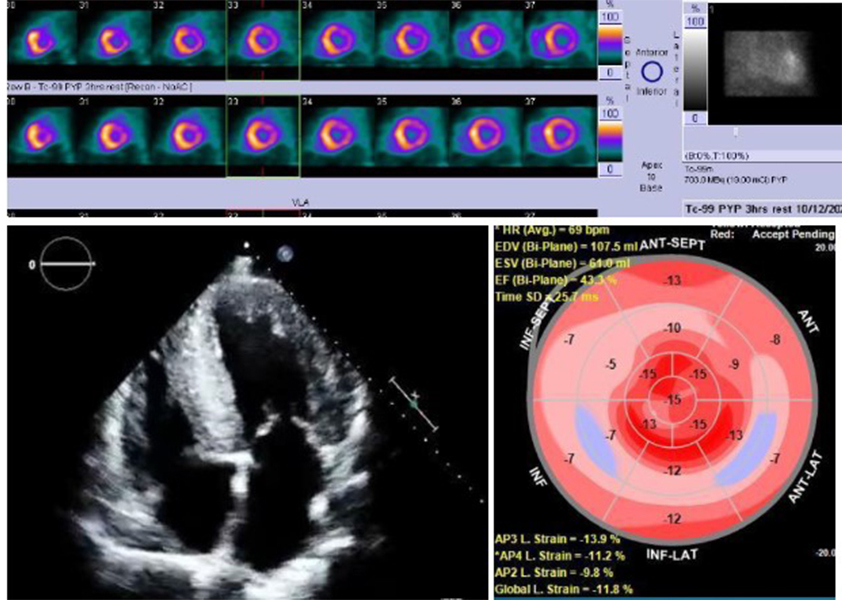 Cardiac Amyloidosis