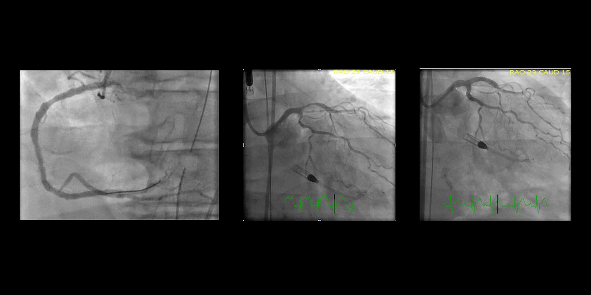 Complex Case Coronary